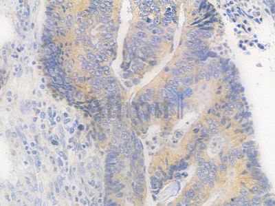 CABP1 Antibody - DF9304 at 1/100 staining human colon carcinoma by IHC-P.