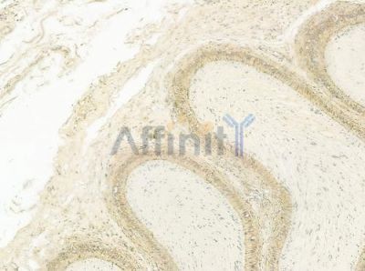 CALML6 Antibody - DF9317 at 1/100 staining human testicular cancer by IHC-P.