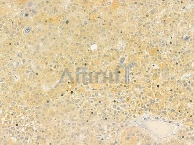 CALML6 Antibody - DF9317 at 1/100 staining human hepatocellular carcinoma by IHC-P.