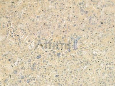 CPD Antibody - DF9339 at 1/100 staining human hepatocellular carcinoma by IHC-P.