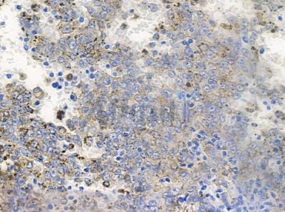 CPO Antibody - DF9340 at 1/100 staining human melanoma by IHC-P.
