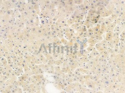 CPZ Antibody - DF9341 at 1/100 staining human hepatocellular carcinoma by IHC-P.