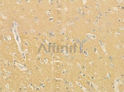 CATSPER4 Antibody - DF9351 at 1/100 staining human glioblastoma by IHC-P.