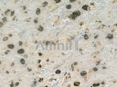 CBX2 Antibody - DF9380 at 1/100 staining human melanoma by IHC-P.