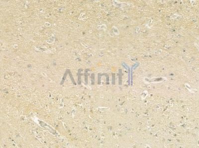 CCDC8 Antibody - DF9405 at 1/100 staining human glioblastoma by IHC-P.