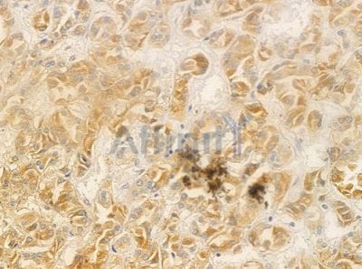 C1QTNF9B Antibody - DF9407 at 1/100 staining human renal cell carcinoma by IHC-P.
