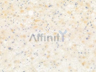 DHRS7 Antibody - DF9437 at 1/100 staining human astrocytoma by IHC-P.