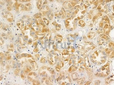 DYNLT1 Antibody - DF9473 at 1/100 staining human renal cell carcinoma by IHC-P.