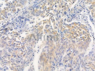 EDC4 Antibody - DF9501 at 1/100 staining human lung squamous cell carcinoma by IHC-P.