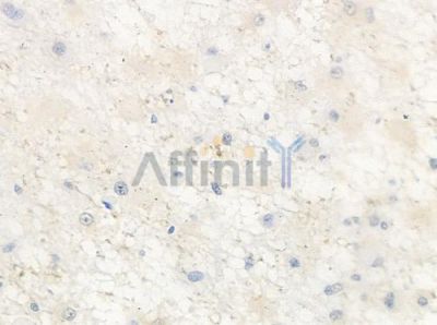 GASP2 Antibody - DF9538 at 1/100 staining human astrocytoma by IHC-P.