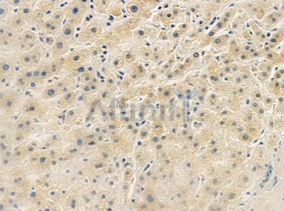 GNB3 Antibody - DF9565 at 1/100 staining human gastric carcinoma by IHC-P.