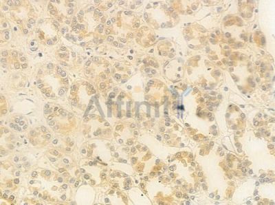 GNL3 Antibody - DF9566 at 1/100 staining human renal cell carcinoma by IHC-P.