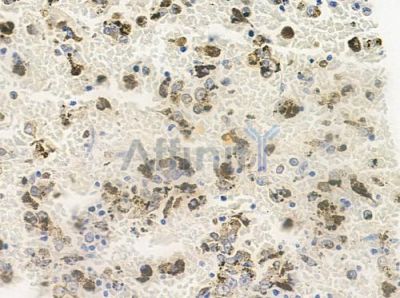 HOXC10 Antibody - DF9579 at 1/100 staining human melanoma by IHC-P.