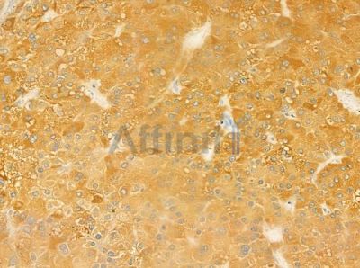 ICAM5 Antibody - DF9596 at 1/100 staining human hepatocellular carcinoma by IHC-P.
