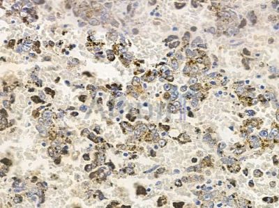 KIR2DS5 Antibody - DF9601 at 1/100 staining human melanoma by IHC-P.