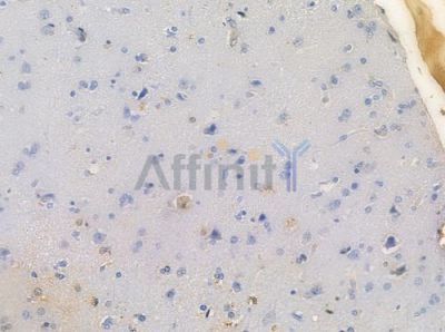 C3orf31 Antibody - DF9631 at 1/100 staining human glioblastoma by IHC-P.