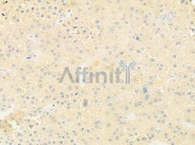MOT9 Antibody - DF9636 at 1/100 staining human hepatocellular carcinoma by IHC-P.
