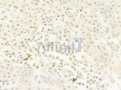 ESCO1 Antibody - DF9657 at 1/100 staining human non-Hodgkin lymphoma by IHC-P.