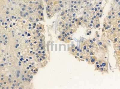 NDUFS8 Antibody - DF9672 at 1/100 staining human hepatocellular carcinoma by IHC-P.
