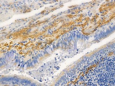 NPHP1 Antibody - DF9678 at 1/100 staining human lung squamous cell carcinoma by IHC-P.
