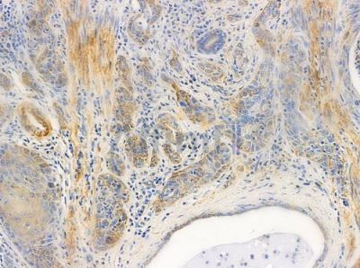 NPHP1 Antibody - DF9678 at 1/100 staining human esophageal carcinoma by IHC-P.