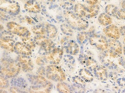 NLGN3 Antibody - DF9692 at 1/100 staining human renal cell carcinoma by IHC-P.
