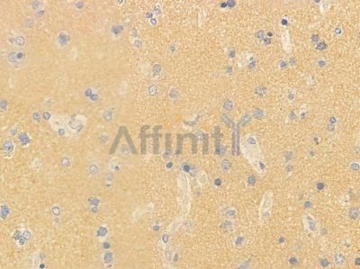 NPS Antibody - DF9702 at 1/100 staining human glioblastoma by IHC-P.