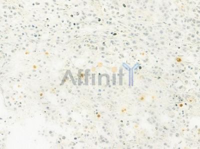 NUP88 Antibody - DF9711 at 1/100 staining human non-Hodgkin lymphoma by IHC-P.