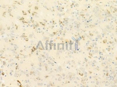 PREX1 Antibody - DF9740 at 1/100 staining human melanoma by IHC-P.