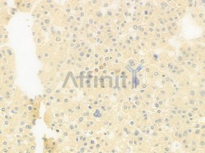 CD42c/GP1BB Antibody - DF9759 at 1/100 staining human hepatocellular carcinoma by IHC-P.