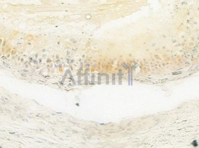 PABPC3 Antibody - DF9761 at 1/100 staining human testicular cancer by IHC-P.