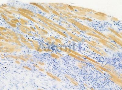 KCNS3 Antibody - DF9769 at 1/100 staining human tongue carcinoma by IHC-P.