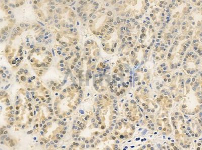 CLP1 Antibody - DF9774 at 1/100 staining human renal cell carcinoma by IHC-P.