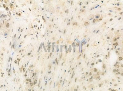 CLP1 Antibody - DF9774 at 1/100 staining human prostate carcinoma by IHC-P.