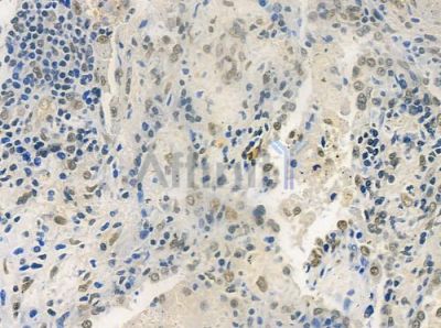 CLP1 Antibody - DF9774 at 1/100 staining human lung squamous cell carcinoma by IHC-P.
