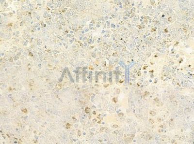 CD164 Antibody - DF9789 at 1/100 staining human melanoma by IHC-P.