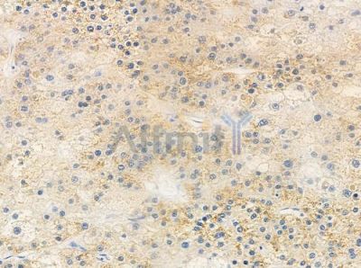 RABL5 Antibody - DF9798 at 1/100 staining human hepatocellular carcinoma by IHC-P.