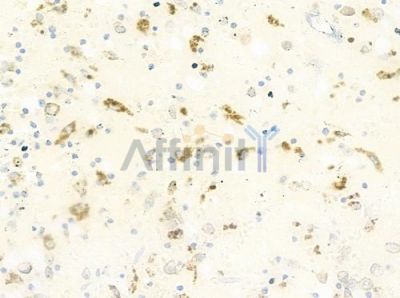 RFTN2 Antibody - DF9799 at 1/100 staining human melanoma by IHC-P.
