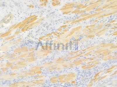 RAB13 Antibody - DF9813 at 1/100 staining human tongue carcinoma by IHC-P.