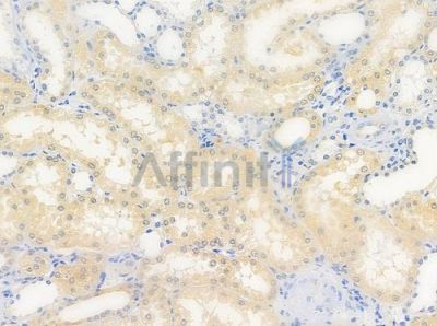 SEPT5 Antibody - DF9881 at 1/100 staining human renal cell carcinoma by IHC-P.