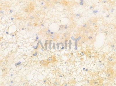 STMN2 Antibody - DF9949 at 1/100 staining human astrocytoma by IHC-P.
