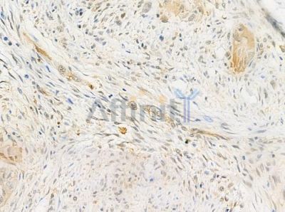 USP26 Antibody - DF9986 at 1/100 staining human tongue carcinoma by IHC-P.