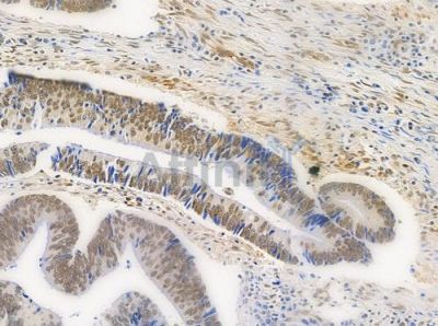USP26 Antibody - DF9986 at 1/100 staining human colon carcinoma by IHC-P.
