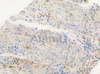 USP34 Antibody - DF9990 at 1/100 staining human colon carcinoma by IHC-P.