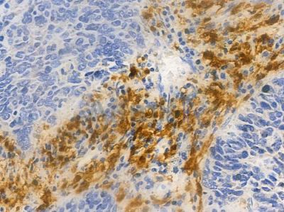 CAPG Antibody - AF0012 at 1/100 staining human large cell lung carcinoma by IHC-P.