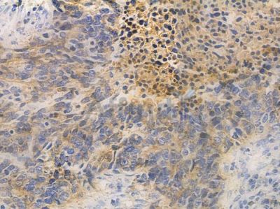 Catenin gamma Antibody - AF0125 at 1/100 staining human large cell lung carcinoma by IHC-P.