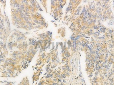 Catenin gamma Antibody - AF0125 at 1/100 staining human lung squamous cell carcinoma by IHC-P.