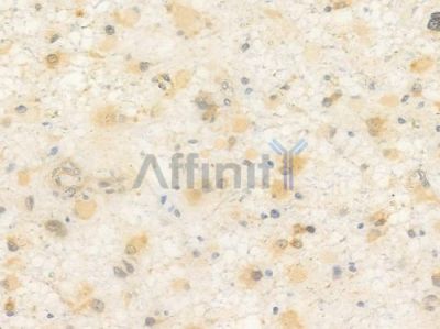 OCT3 Antibody - AF0226 at 1/100 staining human astrocytoma by IHC-P.
