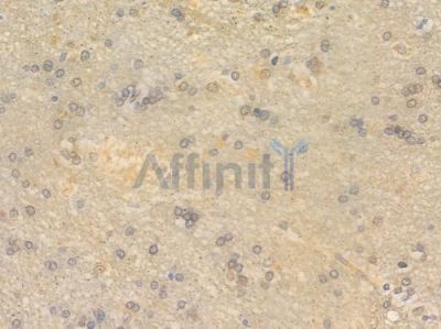 OCT3 Antibody - AF0226 at 1/100 staining human glioblastoma by IHC-P.