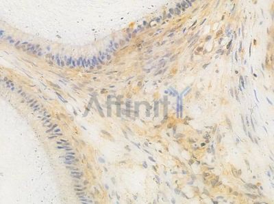 AOS1 Antibody - AF0266 at 1/100 staining human testicular cancer by IHC-P.